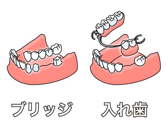 インプラントとは何か からメリット デメリット 治療費 Q Aまで 六本松おおほ歯科